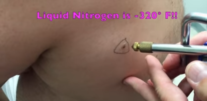 500ml Liquid nitrogen spray gun cryotherapy gun